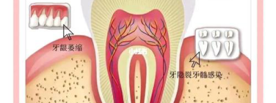 口腔健康新解惑如何避免牙齿敏感？