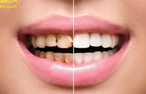 最新口腔护理大咖！如何打造健康白亮牙？